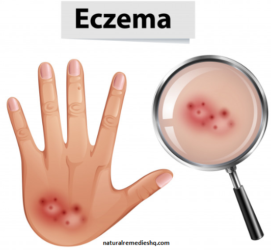 How to get rid of Eczema naturally